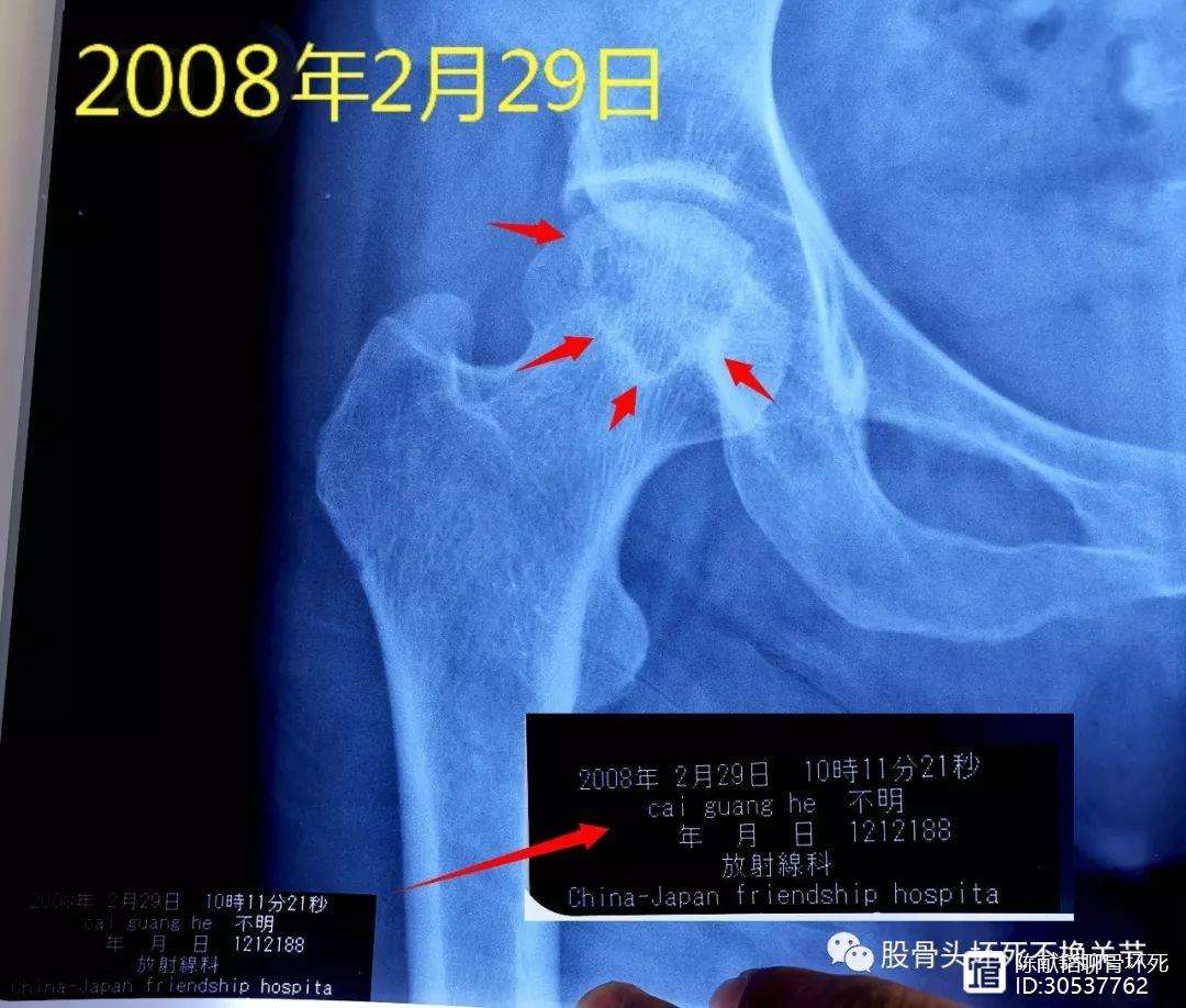 岳阳人工骨头医保报销多少(人工骨头医保报销多少比例)